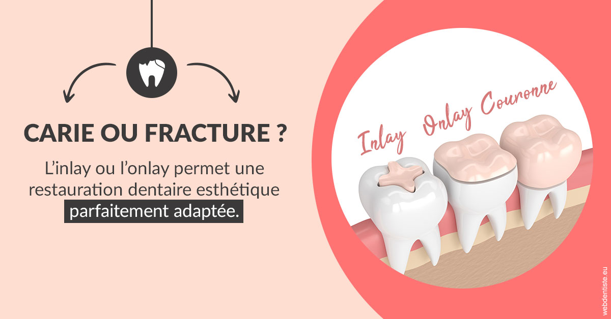 https://dr-dubois-jean-marc.chirurgiens-dentistes.fr/T2 2023 - Carie ou fracture 2