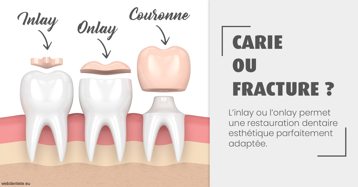 https://dr-dubois-jean-marc.chirurgiens-dentistes.fr/T2 2023 - Carie ou fracture 1