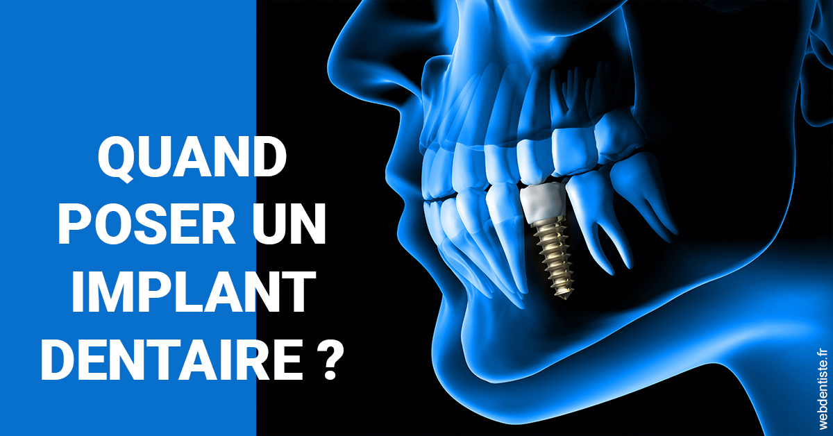 https://dr-dubois-jean-marc.chirurgiens-dentistes.fr/Les implants 1