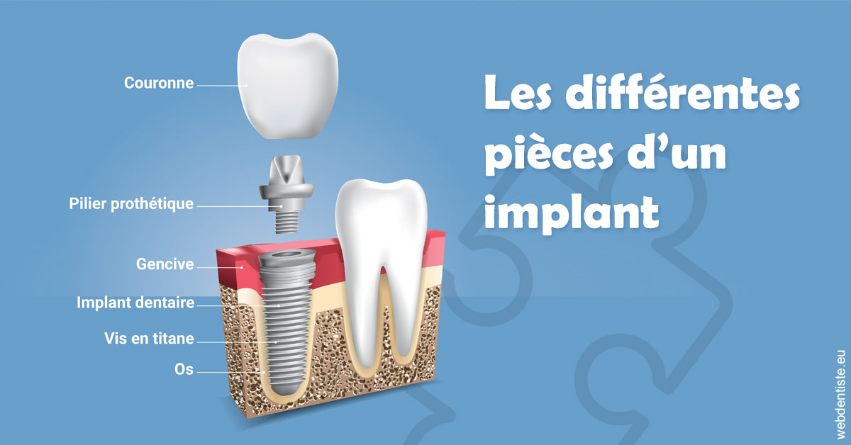 https://dr-dubois-jean-marc.chirurgiens-dentistes.fr/Les différentes pièces d’un implant 1