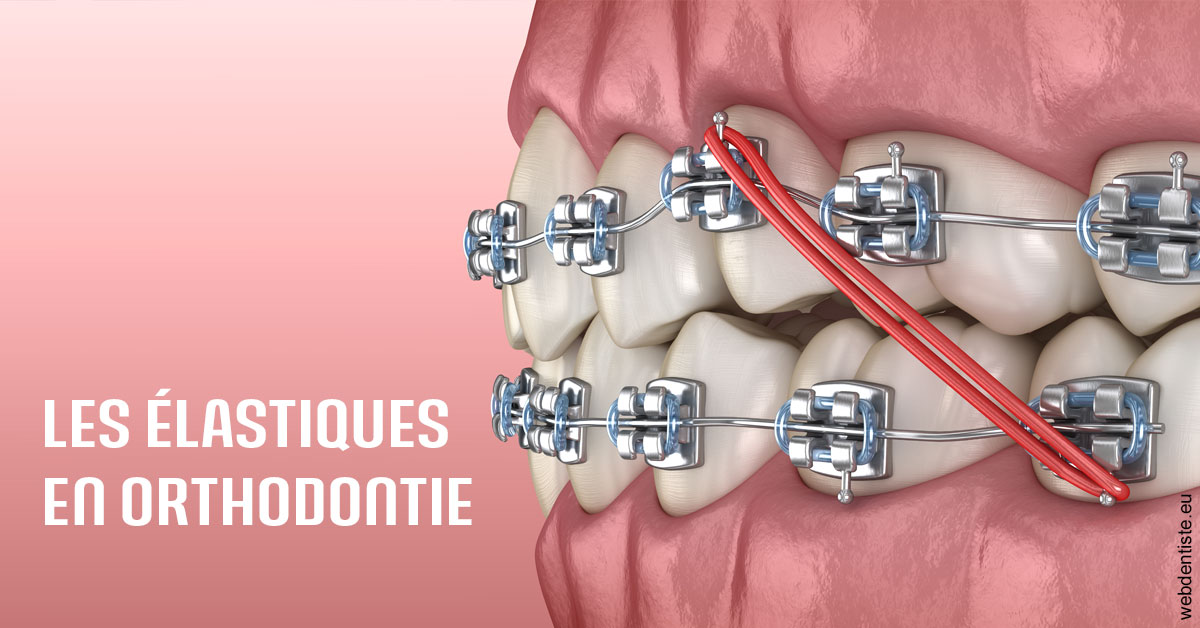 https://dr-dubois-jean-marc.chirurgiens-dentistes.fr/Elastiques orthodontie 2